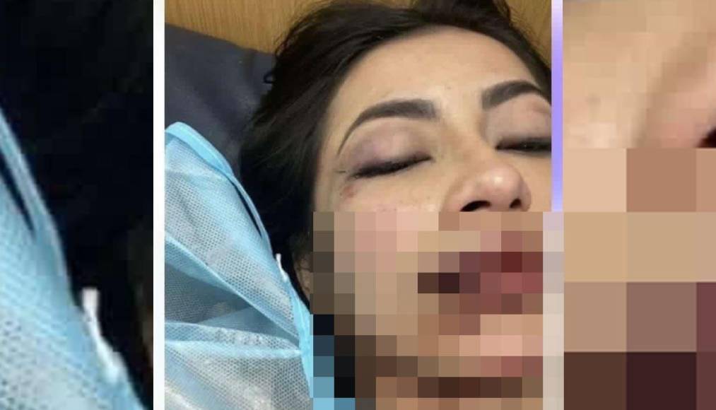 Luego, Isaac Sandoval abordó su vehículo y de retroceso golpeo a Daniela Aldana, que al perder el conocimento fue trasladada al hospital Mario Catarino Rivas.