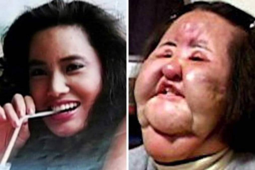FOTOS: Famosos que se hicieron tan adictos a la cirugías y el botox que deformaron su rostro