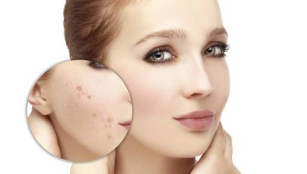 El acné, una condición que afecta el autoestima
