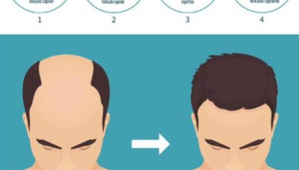 Trasplante capilar en Honduras: 9 cosas que debes saber