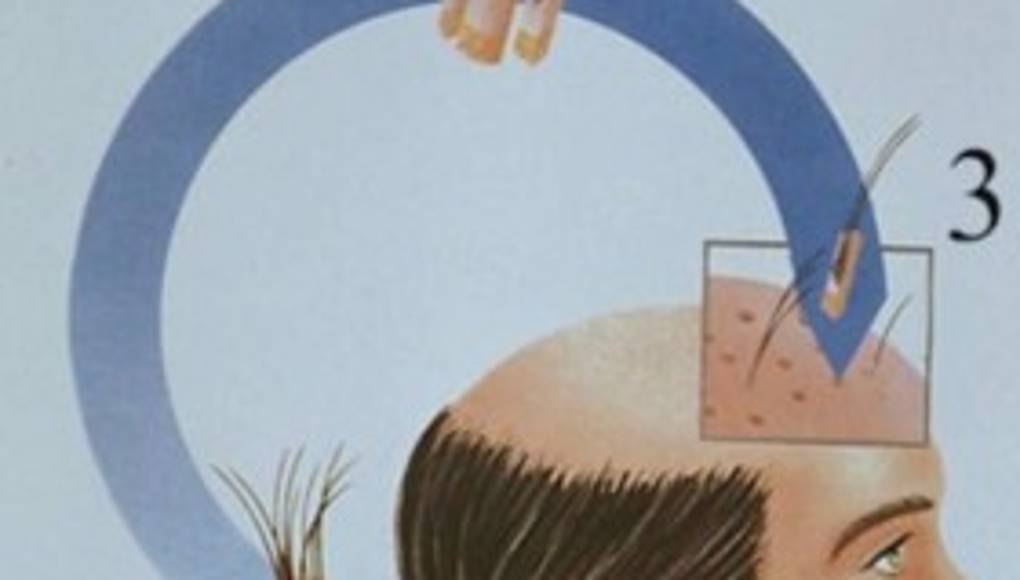 Trasplante capilar en Honduras: 9 cosas que debes saber