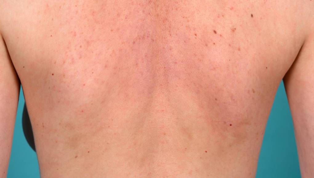¿Por qué aparecen lunares rojos en la piel?