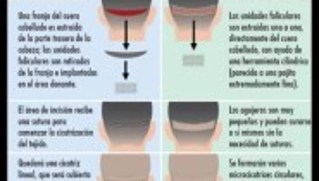 Trasplante capilar en Honduras: 9 cosas que debes saber