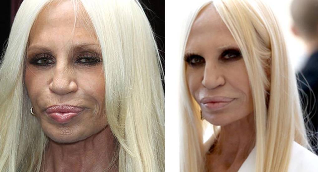 Donatella Versace: A través de los años, la hermana de Gianni Versace, cometió varios abusos en su rostro para mantener su juventud. Sin embargo, este empezó a deformarse con las cirugías estéticas que se realizaba, estas se hicieron muy notorias en 2015 durante el Fashion Week de Milán.