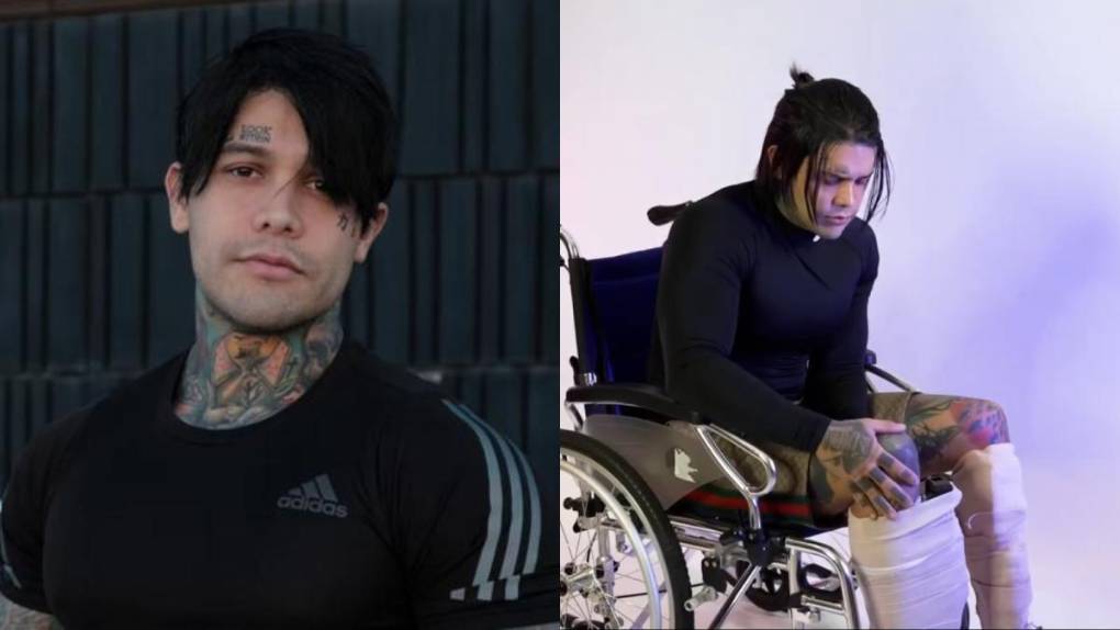 Hace casi un año, a finales de septiembre de 2023, se conoció la noticia de que el creador de contenido Yeferson Cossio se sometería al alargamiento de una zona de su cuerpo. Aunque en su momento no confirmó más detalles, días más tarde reveló que sería una de las “cirugías más dolorosas del mundo” para aumentar su estatura.