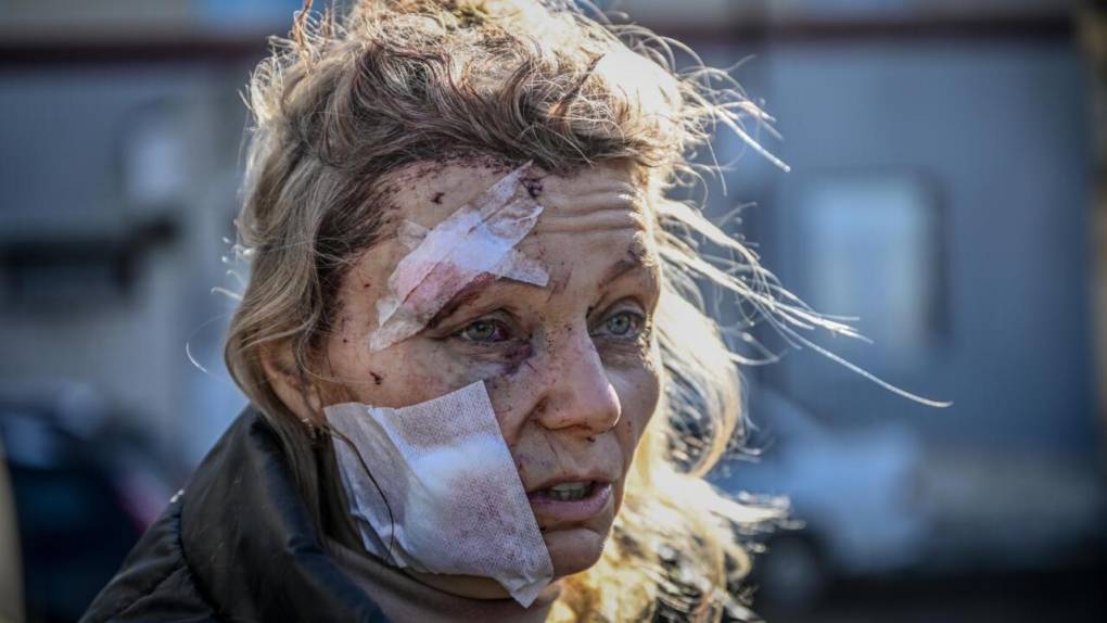 El shock exhibido en el rostro cubierto de vendas de Olena Kurilo, una enseñante herida en un bombardeo en la ciudad de Chuguev, en el este de <b>Ucrania</b>, refleja el de todo un país. Su resistencia, también. “Nunca, bajo ninguna condición, me someteré a Putin. Es mejor morir”, dice Kurilo, cuya fotografía se convierte en una de las imágenes simbólicas de la <b>guerra</b>.