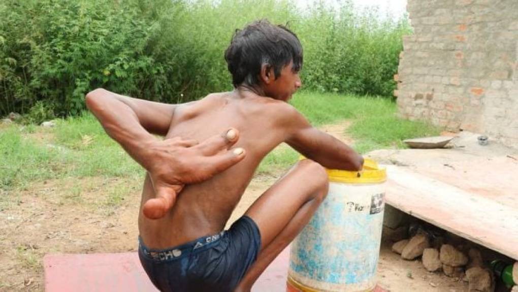 El joven hindú tiene 12 años y sus manos miden más de 30 centímetros. Fuente: Infobae