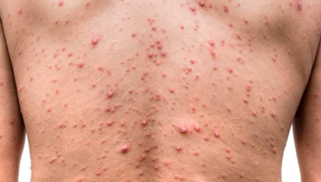 Los síntomas de la viruela del mono incluyen fiebre, dolores musculares e inflamación de los ganglios linfáticos, antes de provocar una erupción parecida a la varicela en el rostro y el cuerpo. La viruela del mono está causada por un virus endémico en África central y occidental.