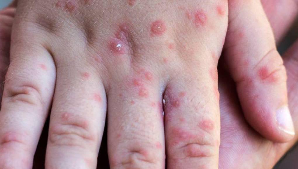 Honduras, el país número 25 de América que confirma un caso de viruela del mono