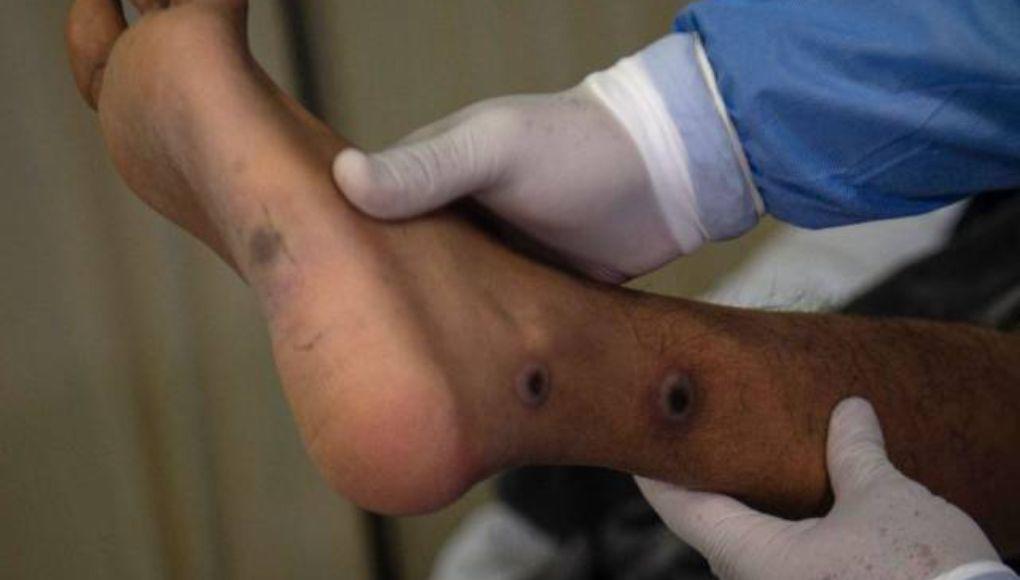 Ascienden a seis los casos sospechosos de viruela del mono en San Pedro Sula