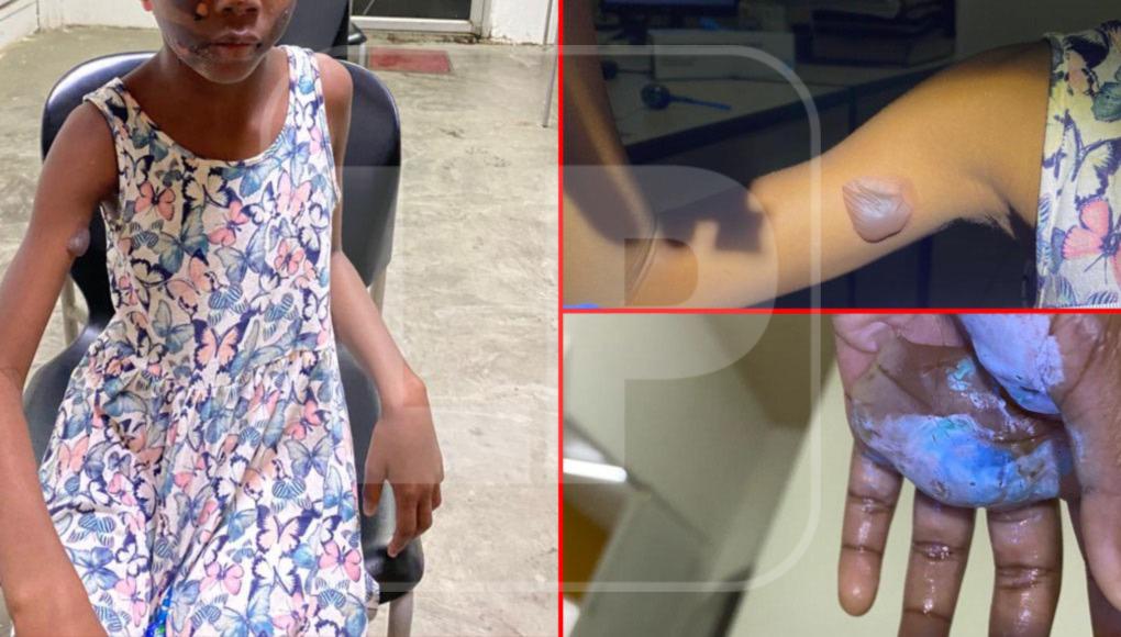 Madre quema a su hija como castigo en El Progreso; la mujer fue arrestada