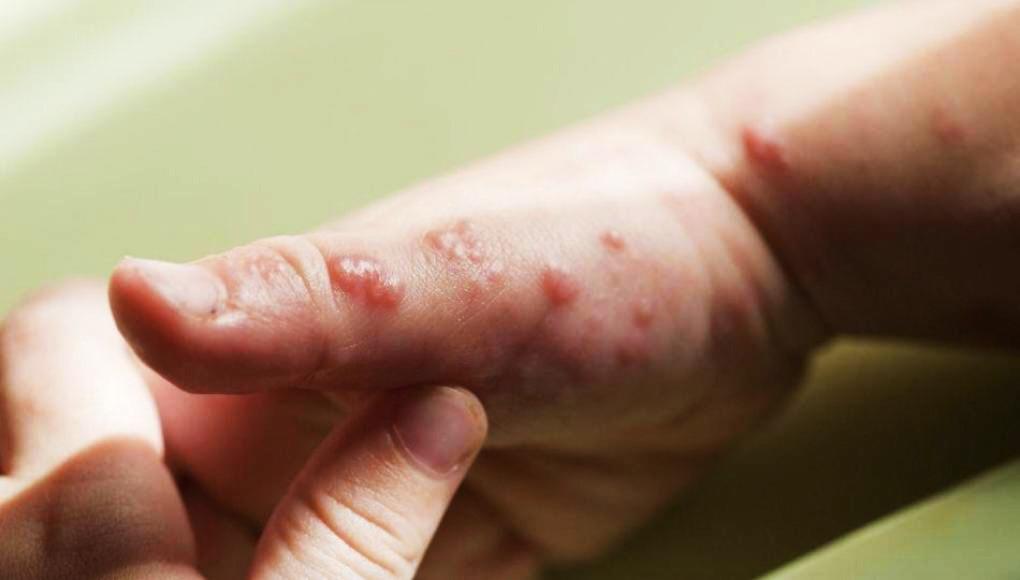 Honduras registra el segundo caso de viruela del mono