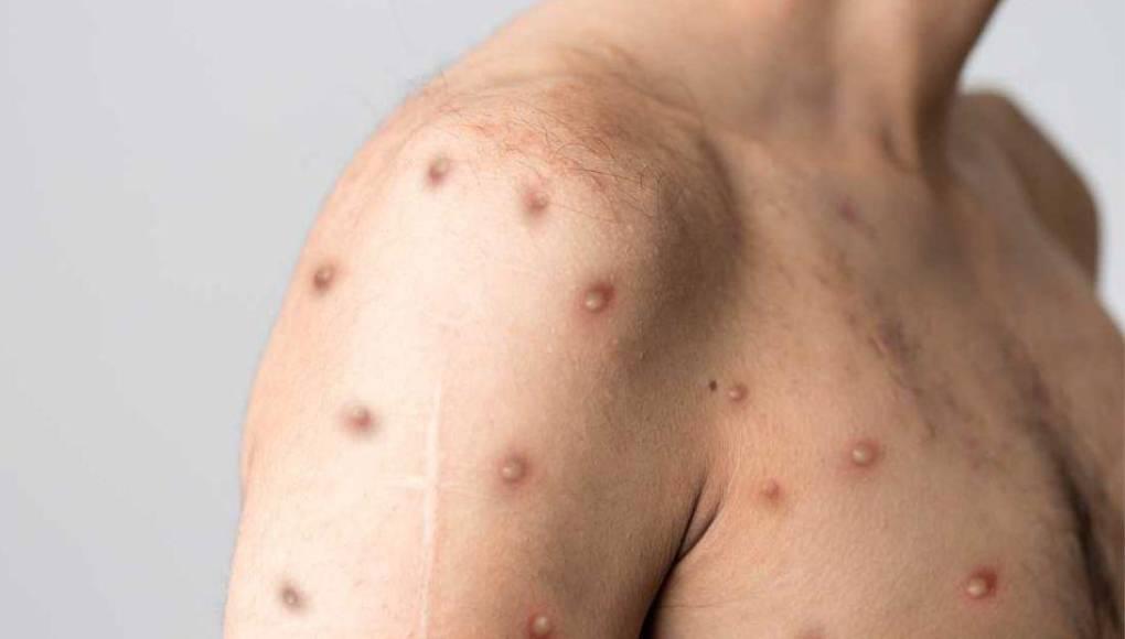 Familia de Lempira está en vigilancia por sospecha de viruela del mono