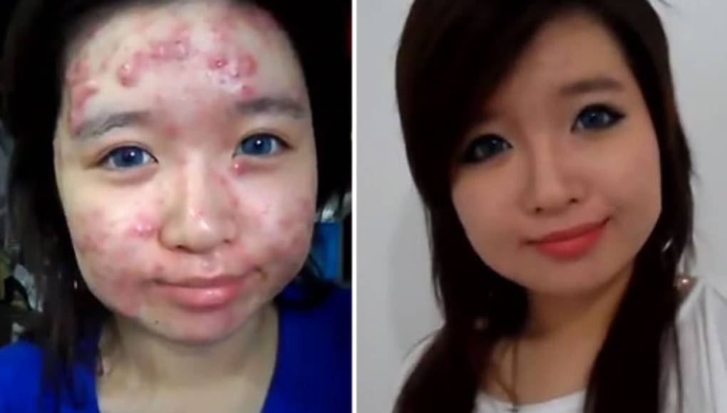 Tutorial sobre cómo ocultar el acné es un éxito en YouTube