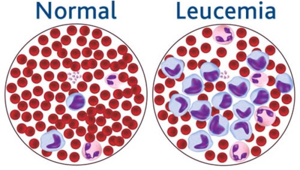 Los factores sociales influyen en la supervivencia a la leucemia