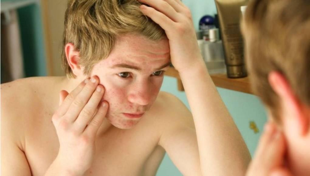 Adolescente atormentado por el acné