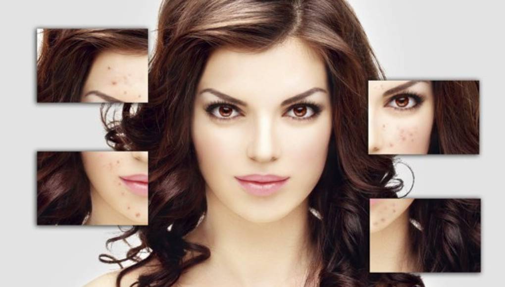 Verdades y mentiras sobre el acné