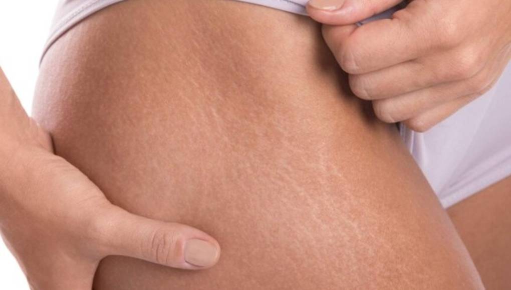 ¿Cómo funciona la vitamina E para las estrías?