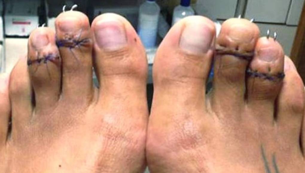 La 'cirugía de la Cenicienta', la nueva moda estética