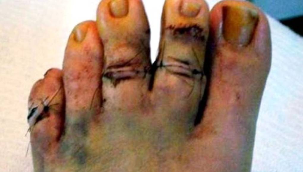 La 'cirugía de la Cenicienta', la nueva moda estética