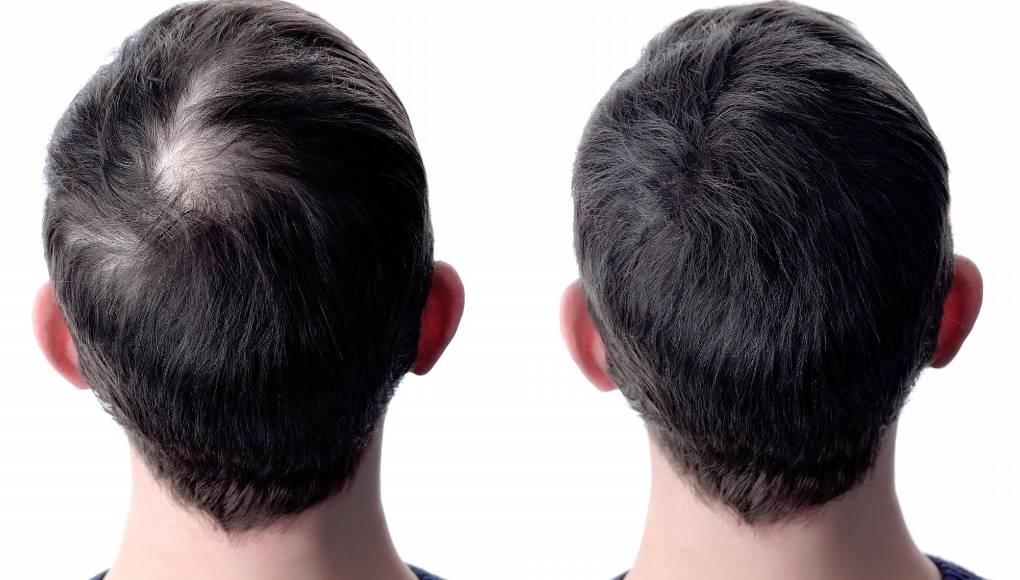 Implantes de cabello para tratar la calvicie