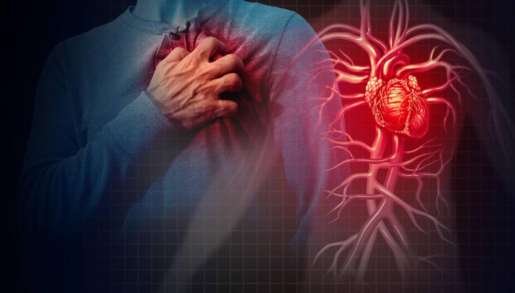 Estenosis e insuficiencia cardiaca, dos males que se confunden con infartos