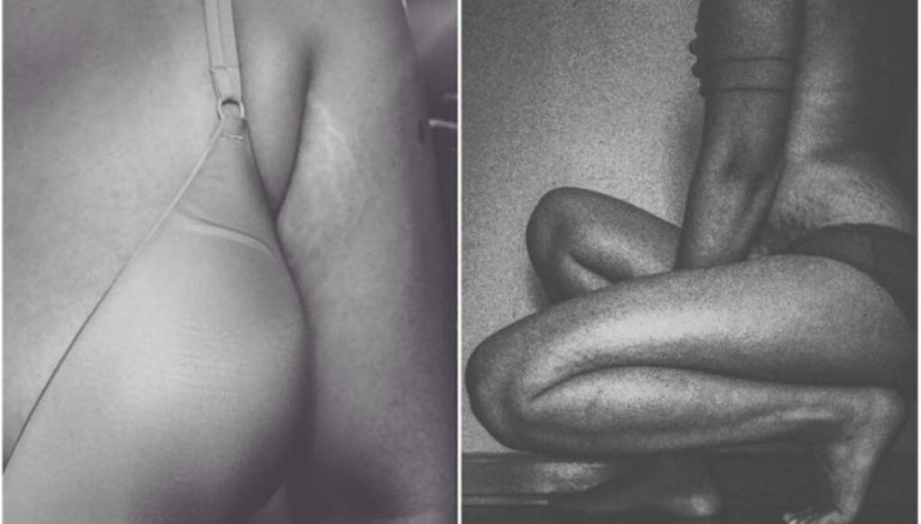 Mujeres comparten fotos de sus estrías para campaña viral