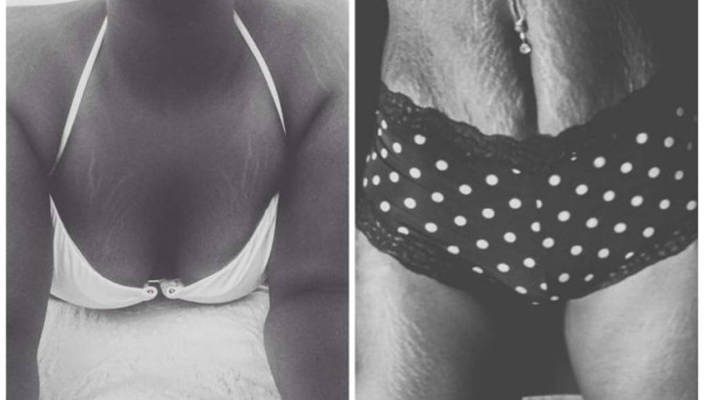 Mujeres comparten fotos de sus estrías para campaña viral
