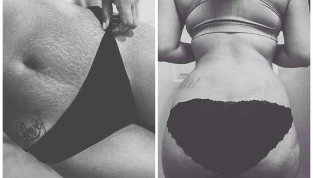 Mujeres comparten fotos de sus estrías para campaña viral