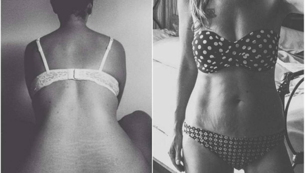 Mujeres comparten fotos de sus estrías para campaña viral