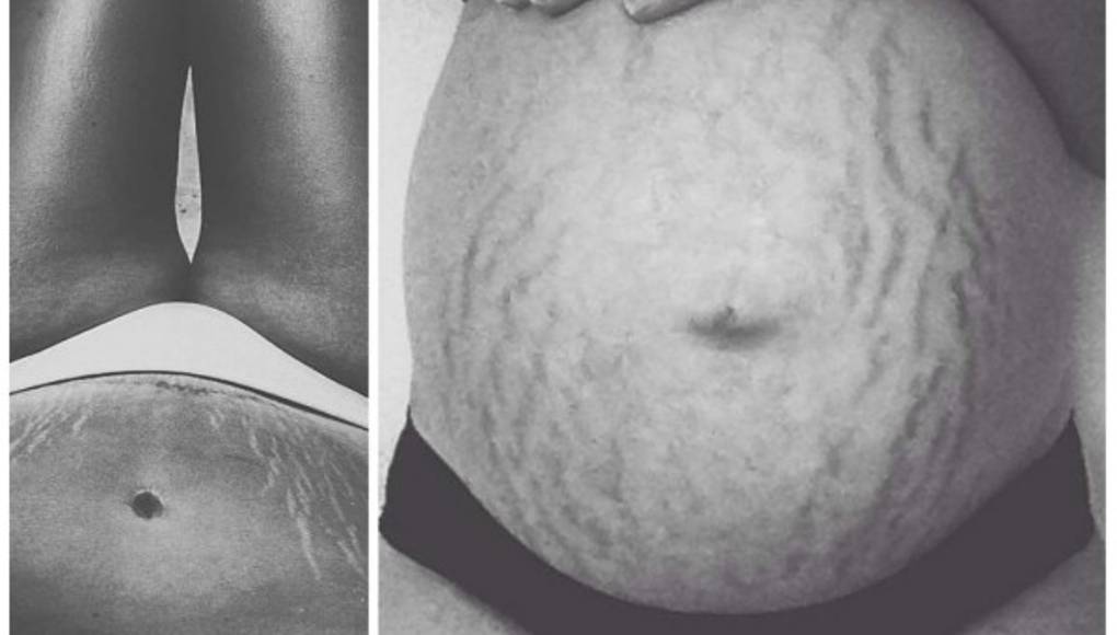 Mujeres comparten fotos de sus estrías para campaña viral