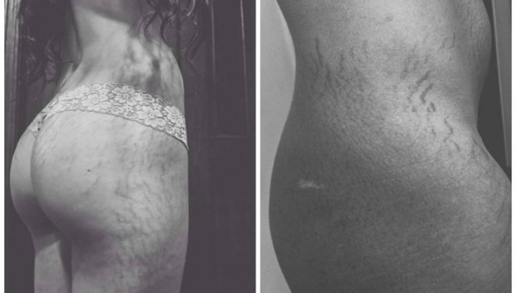 Mujeres comparten fotos de sus estrías para campaña viral