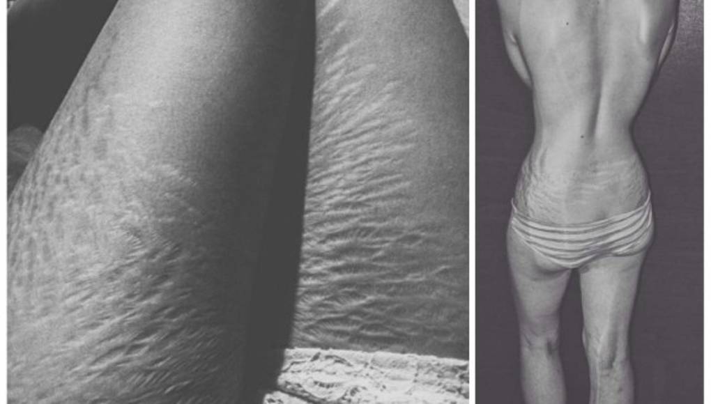 Mujeres comparten fotos de sus estrías para campaña viral