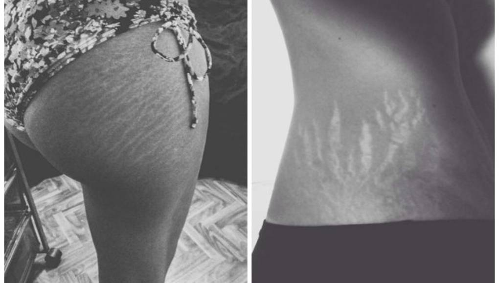 Mujeres comparten fotos de sus estrías para campaña viral