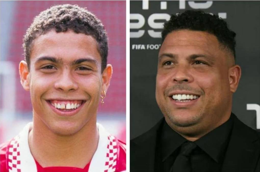 Ronaldo Nazario - La separación tan característica que tenía el brasileño entre los incisivos centrales y que tanto mostró como jugador, desapareció rápidamente cuando abandonó los terrenos de juego.