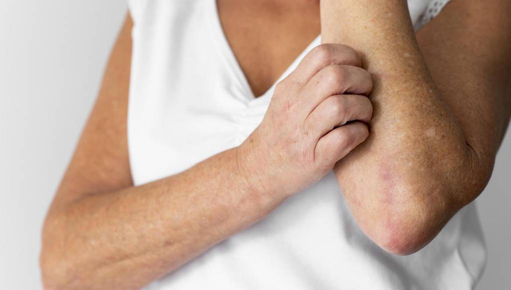 La enfermedad reumatológica se puede manifestar en la piel