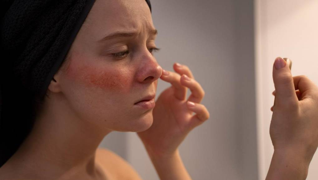 Seis consejos para controlar la rosácea