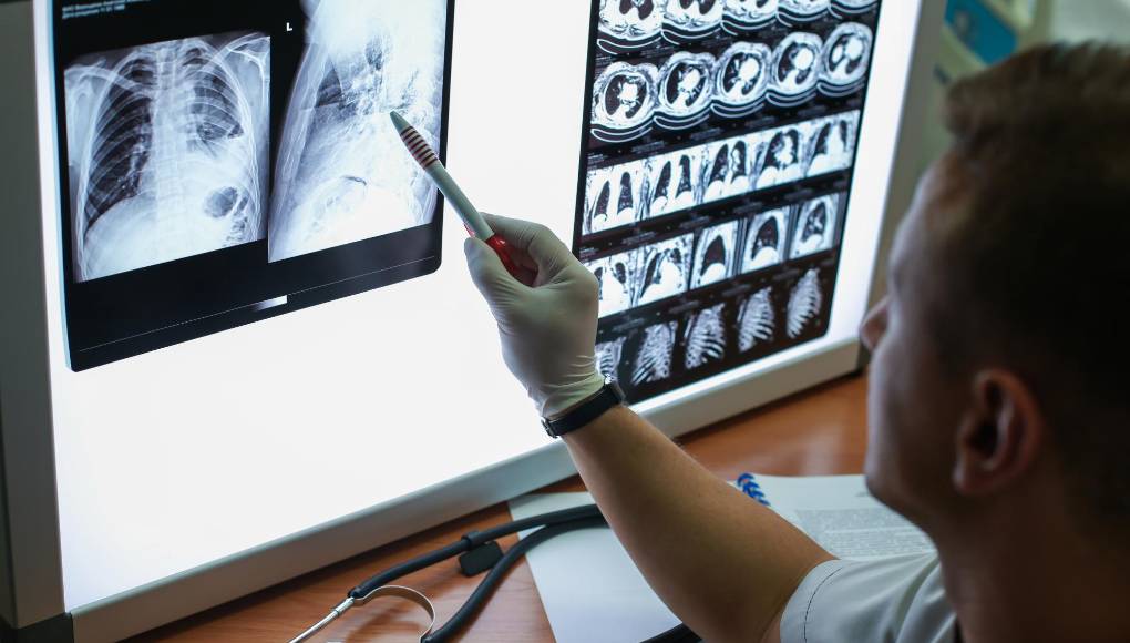Cáncer de pulmón puede incrementar hasta 34 % riesgo de gravedad en covid-19