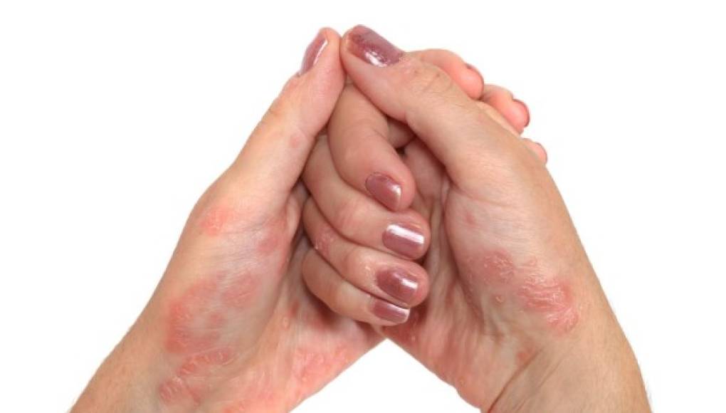 La psoriasis, un mal que afecta la piel y las emociones de quien la sufre