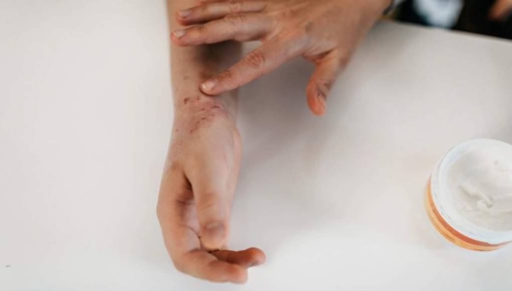 Conozca por qué el COVID-19 está hiperpigmentando la piel y provocando erupciones cutáneas