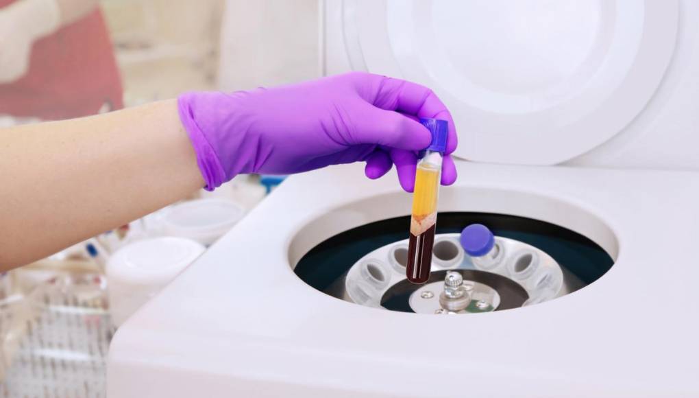 Todo sobre el plasma rico en plaquetas: fuente de la juventud