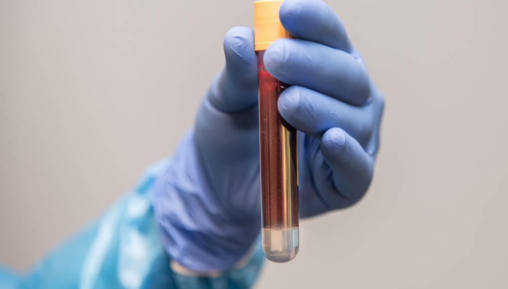 Hemofilia: se necesita más diagnósticos y acceso a tratamientos innovadores