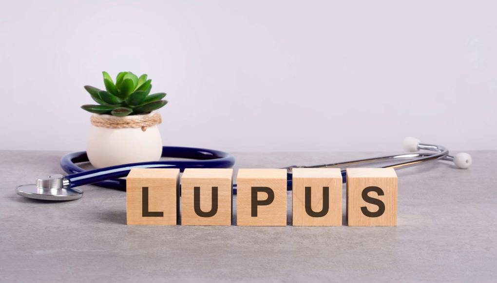 Lupus, origen, síntomas y qué hacer si la padeces
