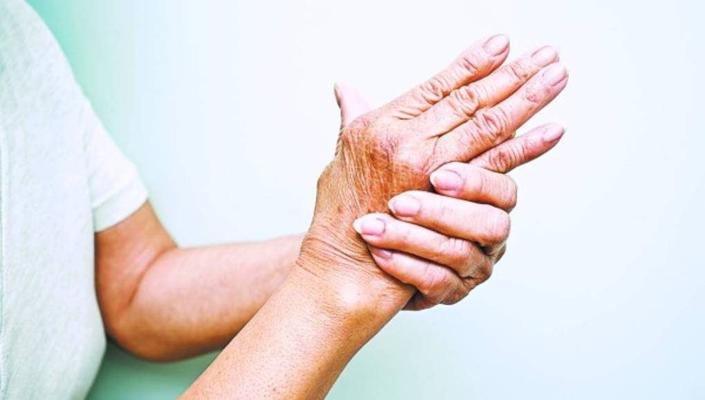 La artritis reumatoide, un mal frecuente en el adulto joven