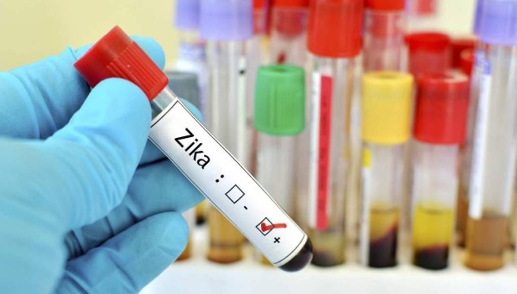 Relacionan el Zika con deformaciones en las extremidades de los recién nacidos