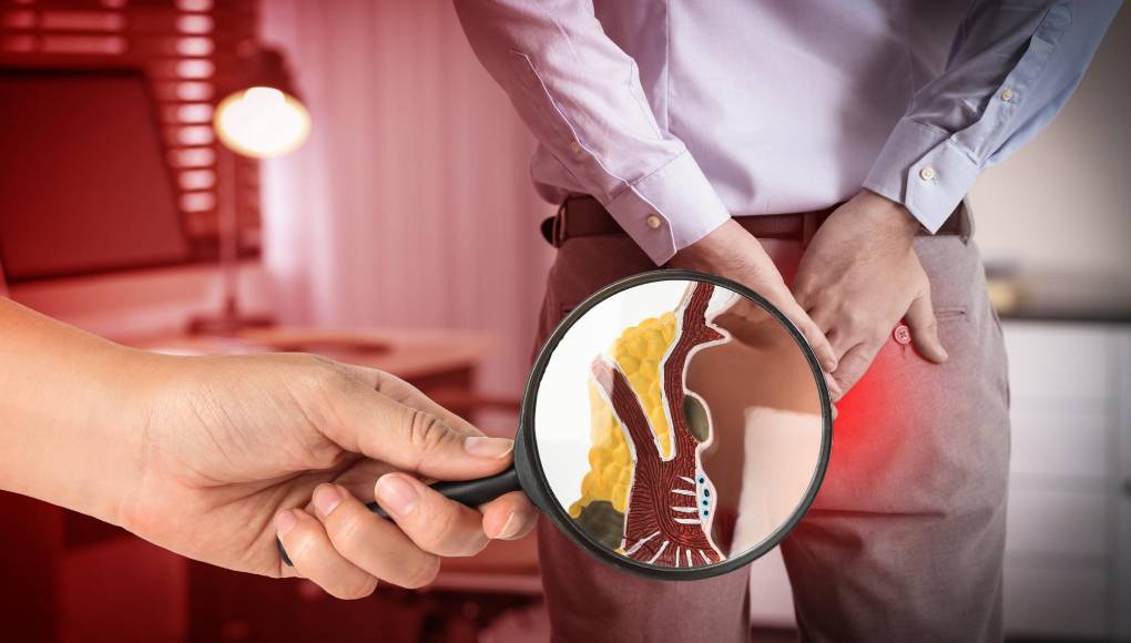 Cáncer de colon suele confundirse con hemorroides