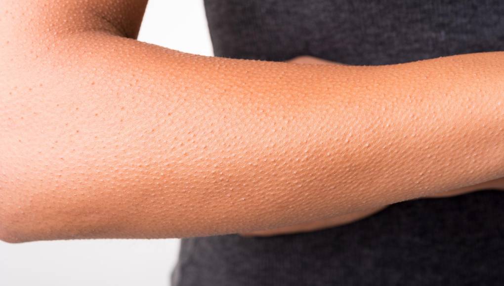 ¿Por qué ocurre la piloerección o “piel de gallina”?