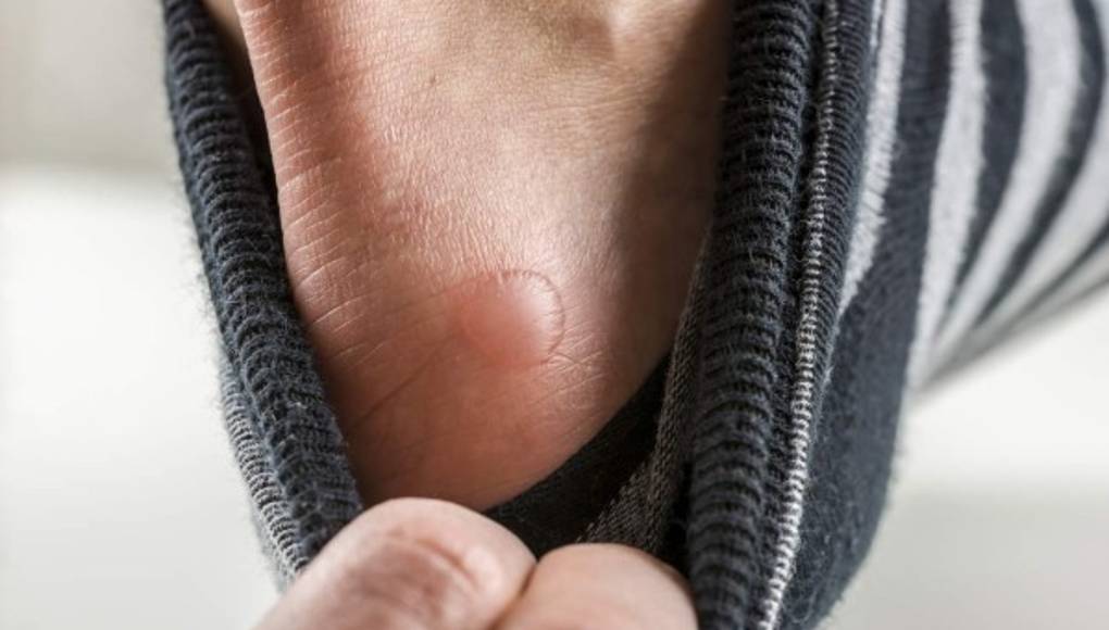 No deje que las dolorosas ampollas arruinen su diversión de verano