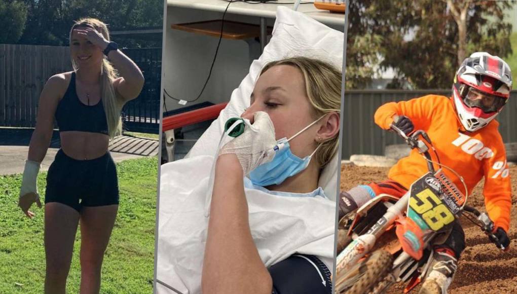 Una joven australiana tuvo un escalofriante accidente en motocross y compartió su experiencia tras sufrir múltiples lesiones en su rostro.