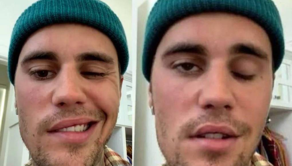 Uno de los momentos más difíciles en la vida de Bieber fue al ser diagnosticado con el síndrome Ramsay Hunt, que le causó parálisis facial.
